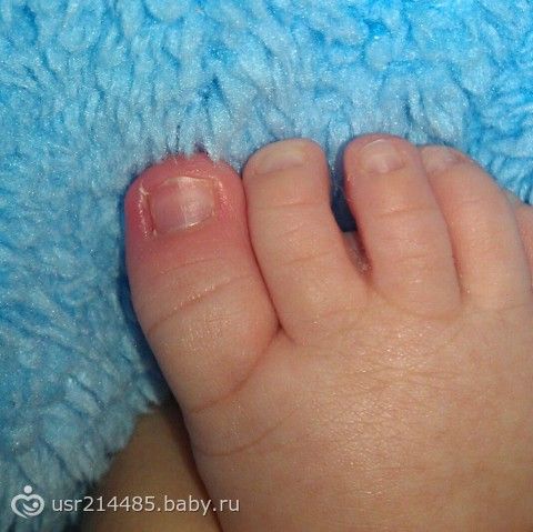 Покраснели ногти на ногах у ребенка Покраснели ногти на ногах у ребенка