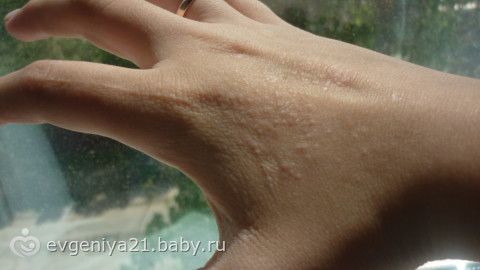 Прыщи на руках только летом Прыщи на руках только летом