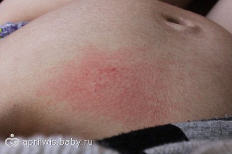 Кожа чешется как бы печет Кожа чешется как бы печет