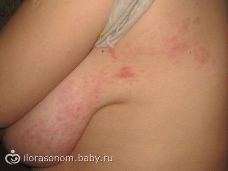 Маленькие красные точки на теле как сыпь Маленькие красные точки на теле как сыпь