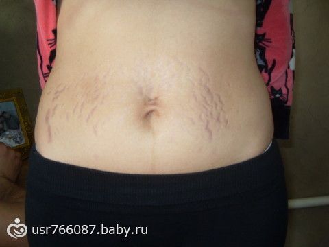 Могут ли растяжки пройти сами по себе Могут ли растяжки пройти сами по себе