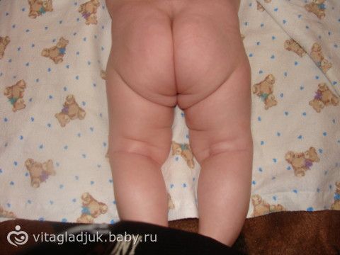 Если у новорожденного неровные складки Если у новорожденного неровные складки