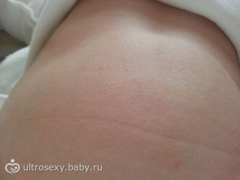 На животе мелкая сыпь день На животе мелкая сыпь день