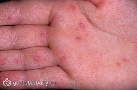 вирусная ангина сыпь