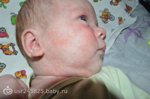 Что принять чтобы прошла сыпь Что принять чтобы прошла сыпь