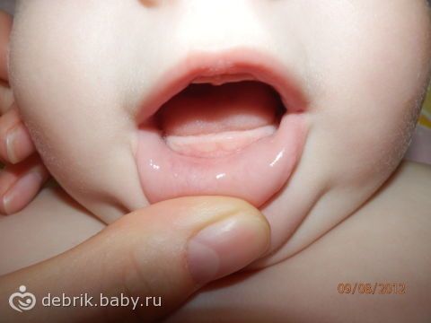 Грудничок побелела нижняя десна Грудничок побелела нижняя десна