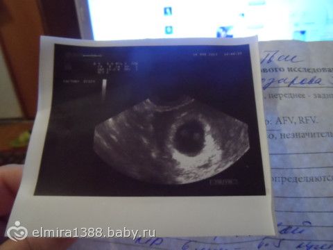 Узи беременной женщины на ранних сроках фото 27