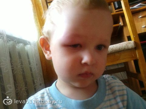 Укусила мошка опухла бровь Укусила мошка опухла бровь