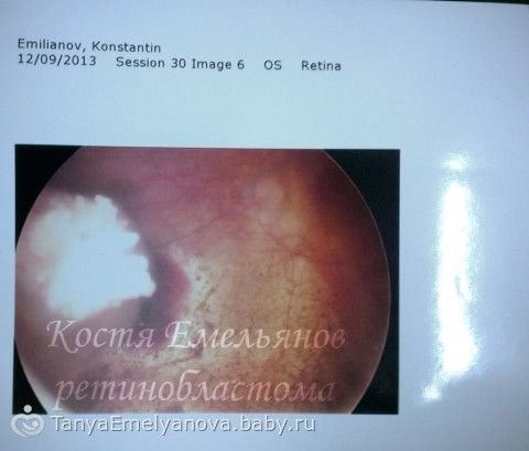 Очень нужна помощь!Костя Емельянов.РАК глаза.Сумма к сбору 337 077руб.(9 235CHF)