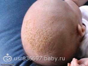 Шелушение кожи головы у новорожденных Шелушение кожи головы у новорожденных