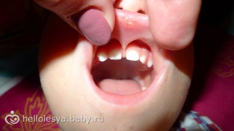 короткая уздечка верхней губы фото онлайн