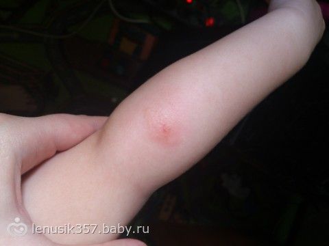укус клеща фото у ребенка онлайн укус клеща фото у ребенка