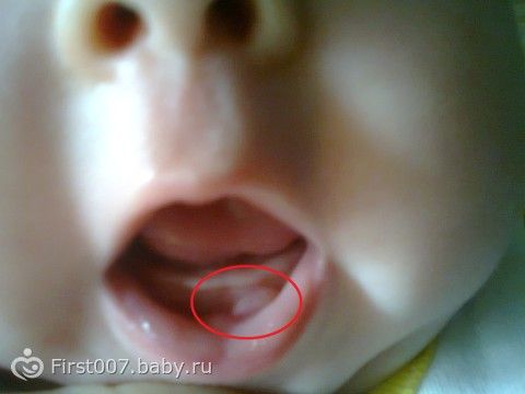 Отросток на губе у младенца. часть2. фото, младенцу 8 месяцев фото