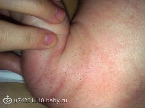 щетинка на спине у новорожденных