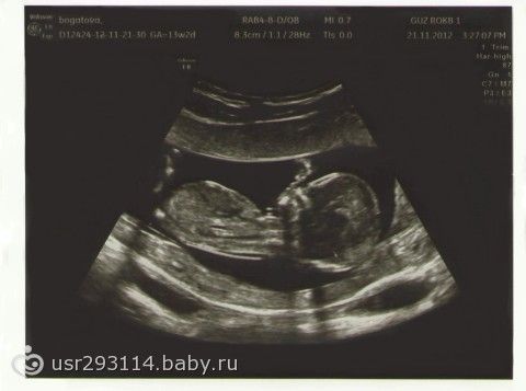 Фото узи ребенка на 14 неделе беременности фото