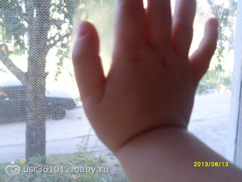 белое пятно у ребенка на кисти руки(